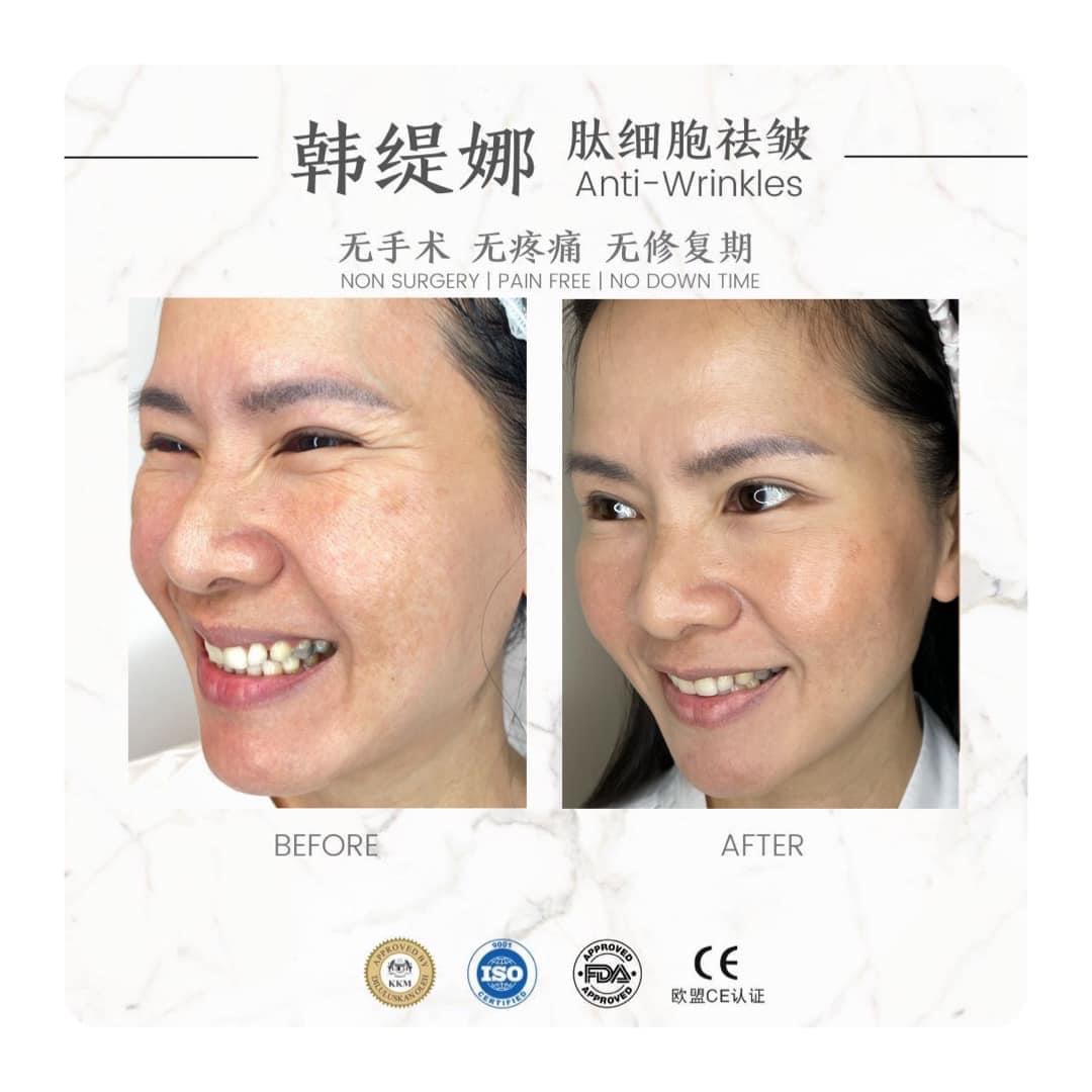 肽细胞去皱