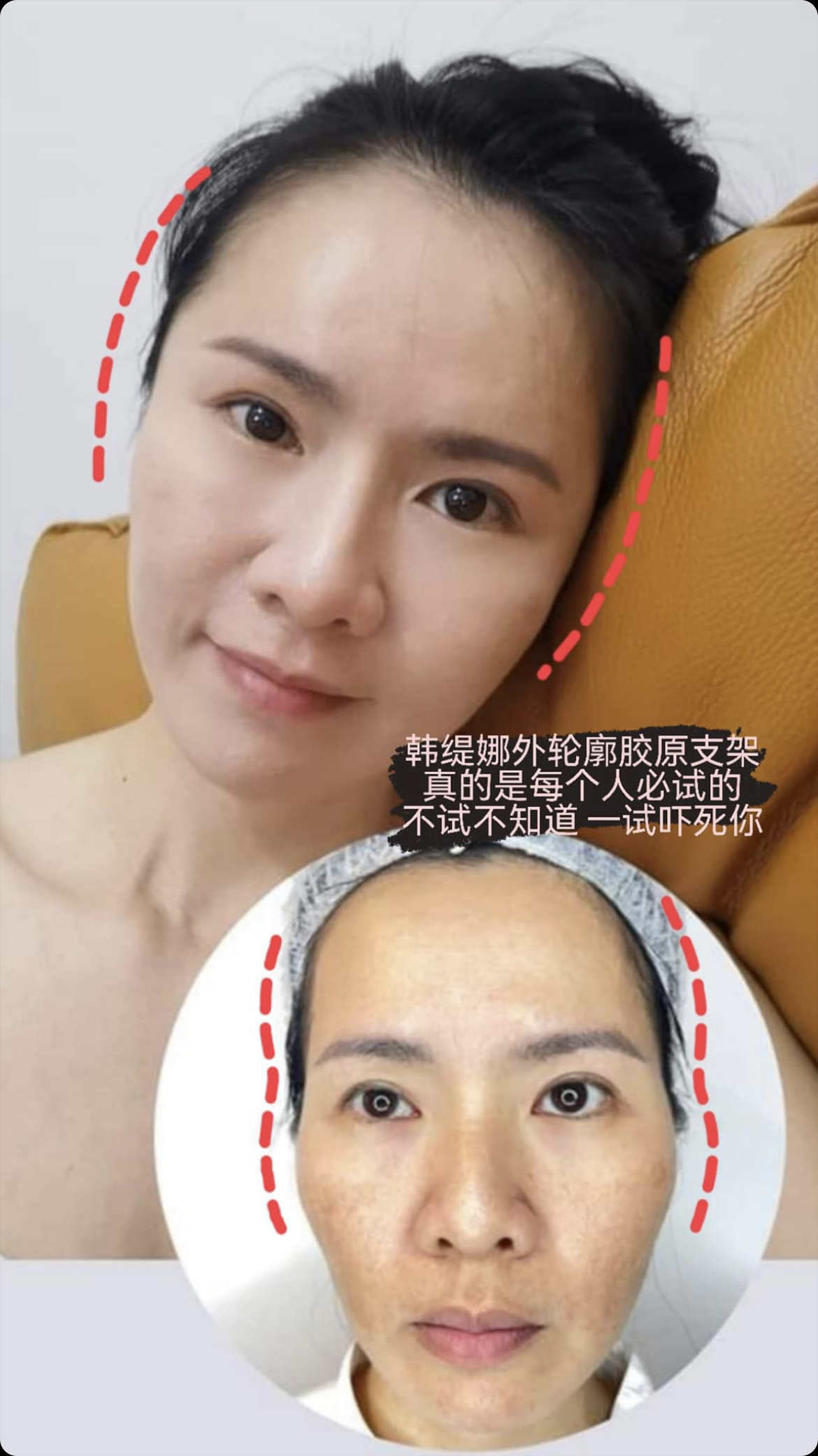 外轮廓胶原支架