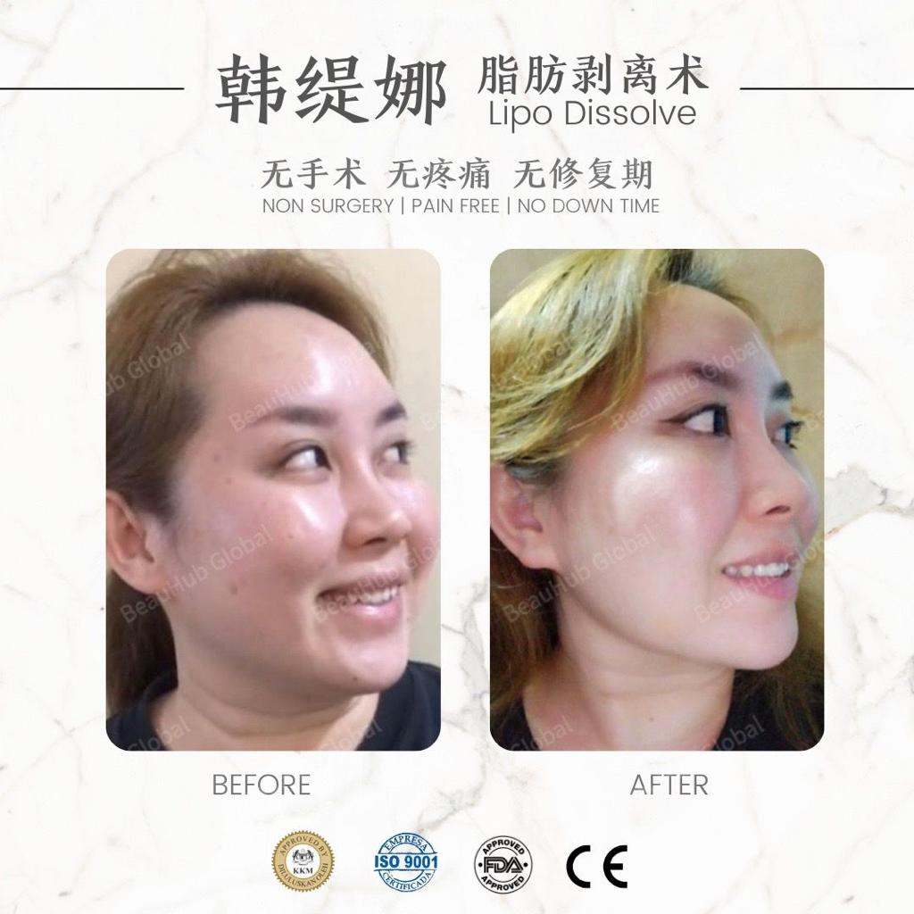 脂肪剥离（减脂）