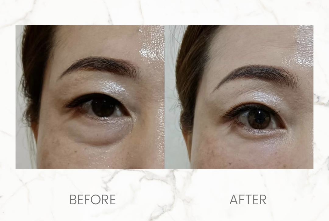 Hartinna Cell Activation