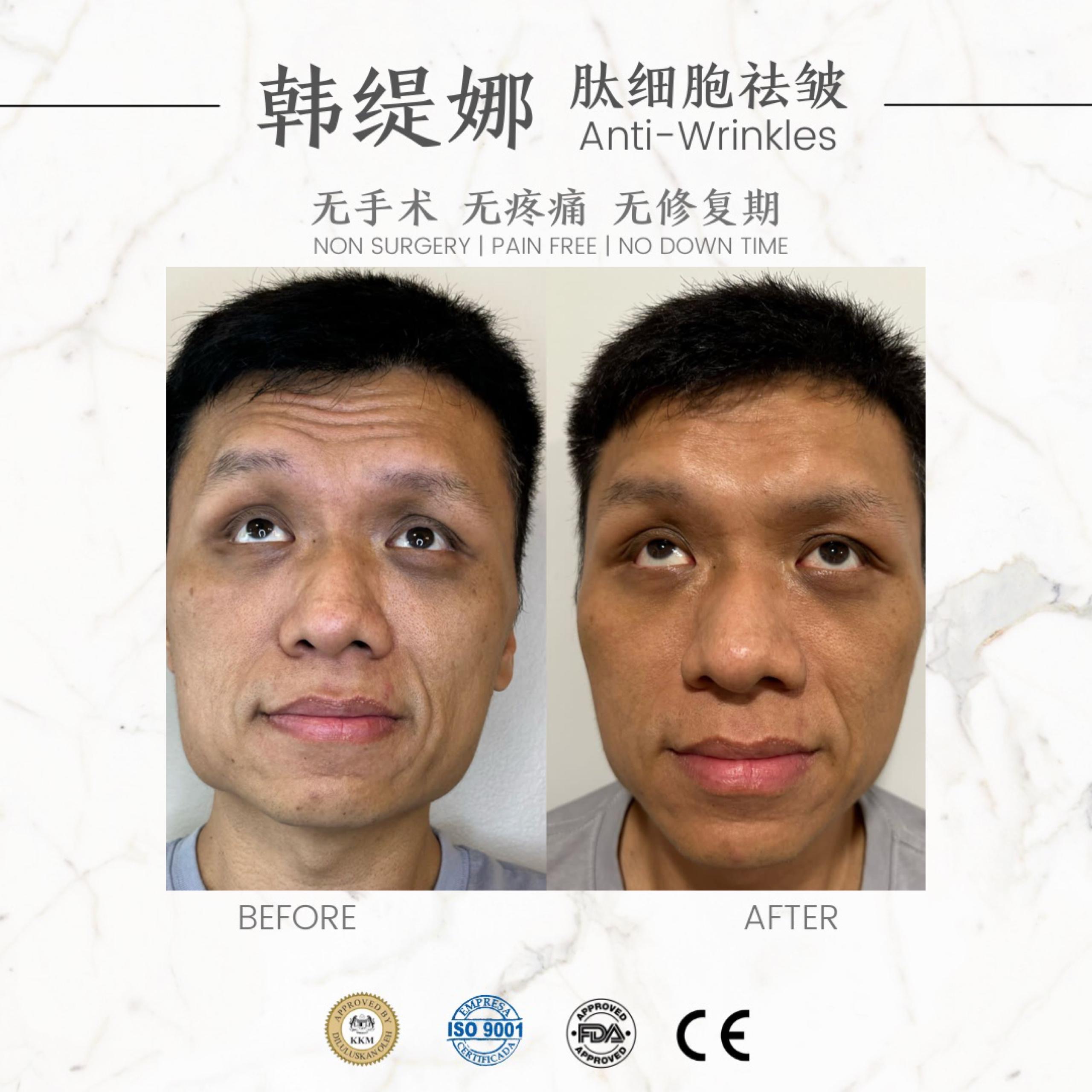 肽细胞去皱