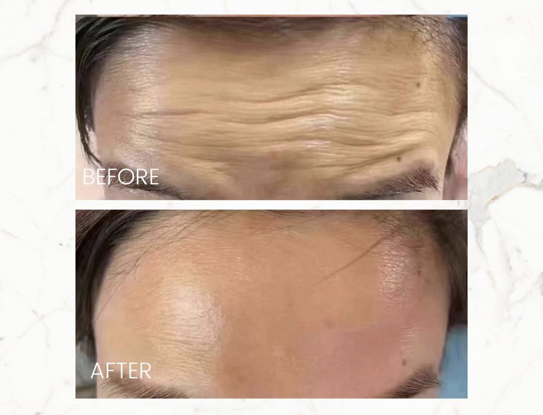 Hartinna Anti-Wrinkles