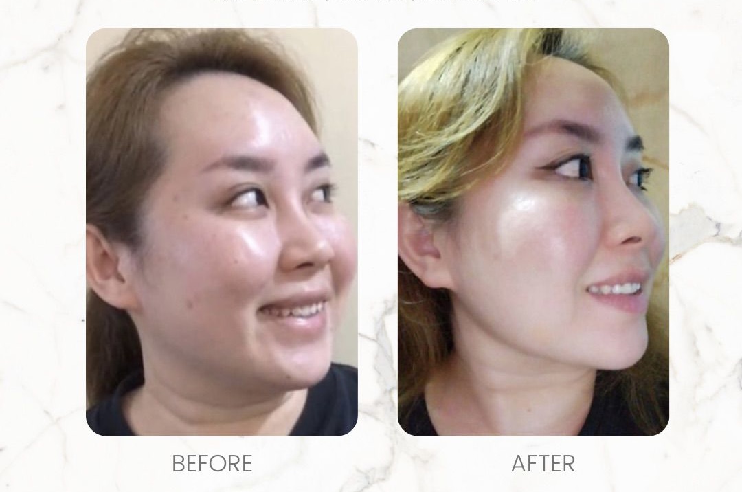 Hartinna Lipodissolve