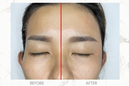 Hartinna Upper Face Contouring