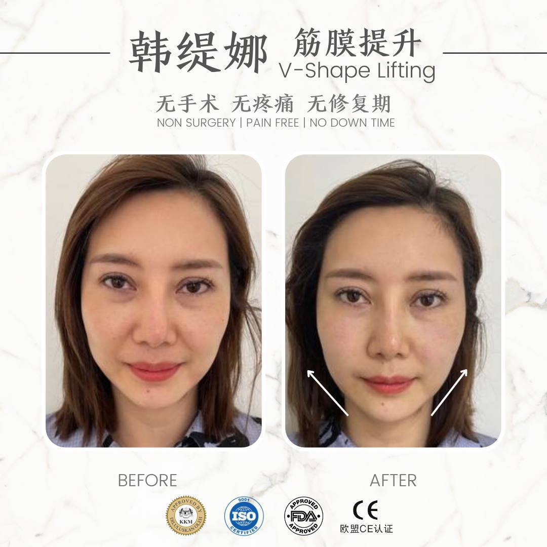 筋膜提升