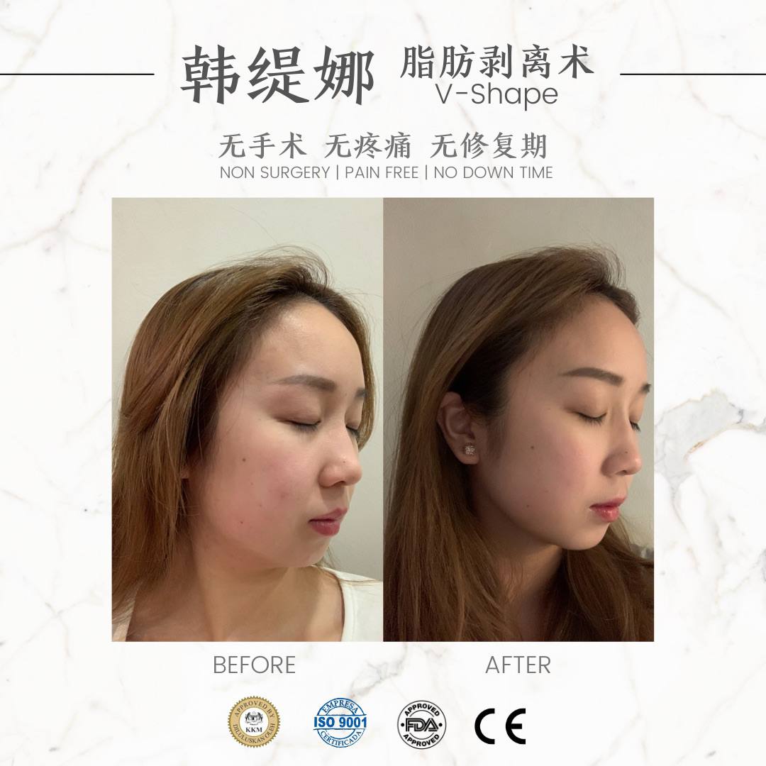 脂肪剥离