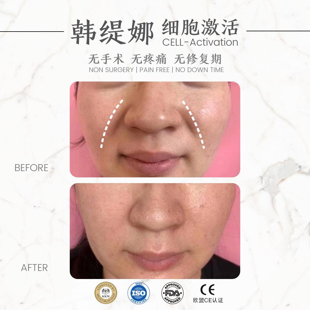 #法令纹 #凹陷 #衰老 统统解决！ 给颜值最加法，给年龄做减法 ✨