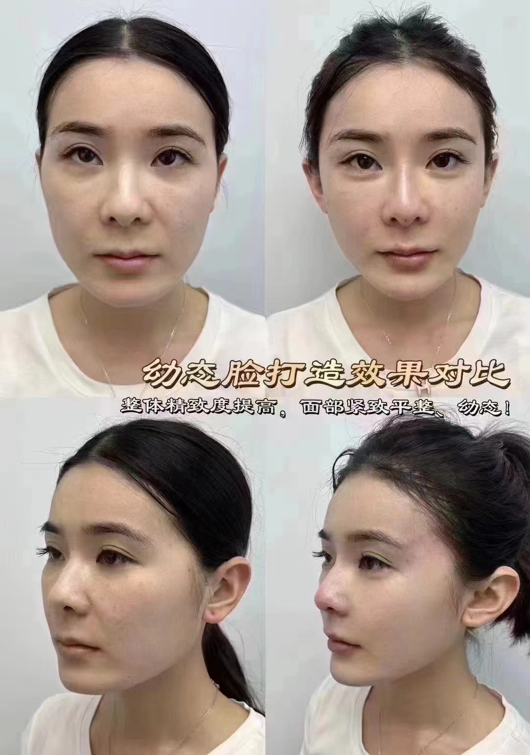 Young girl face treament 少女支架疗程