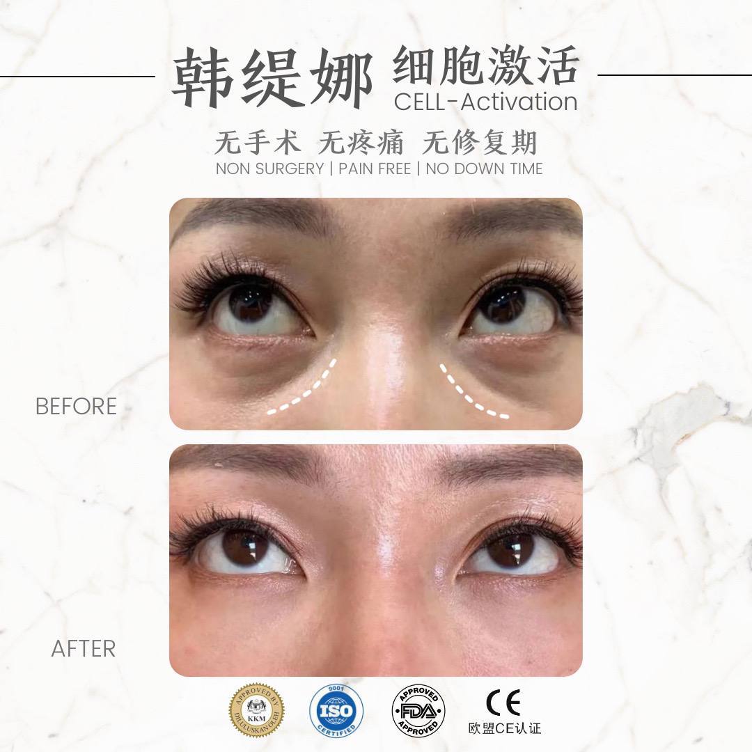 Anti Eye bag 眼袋饱满