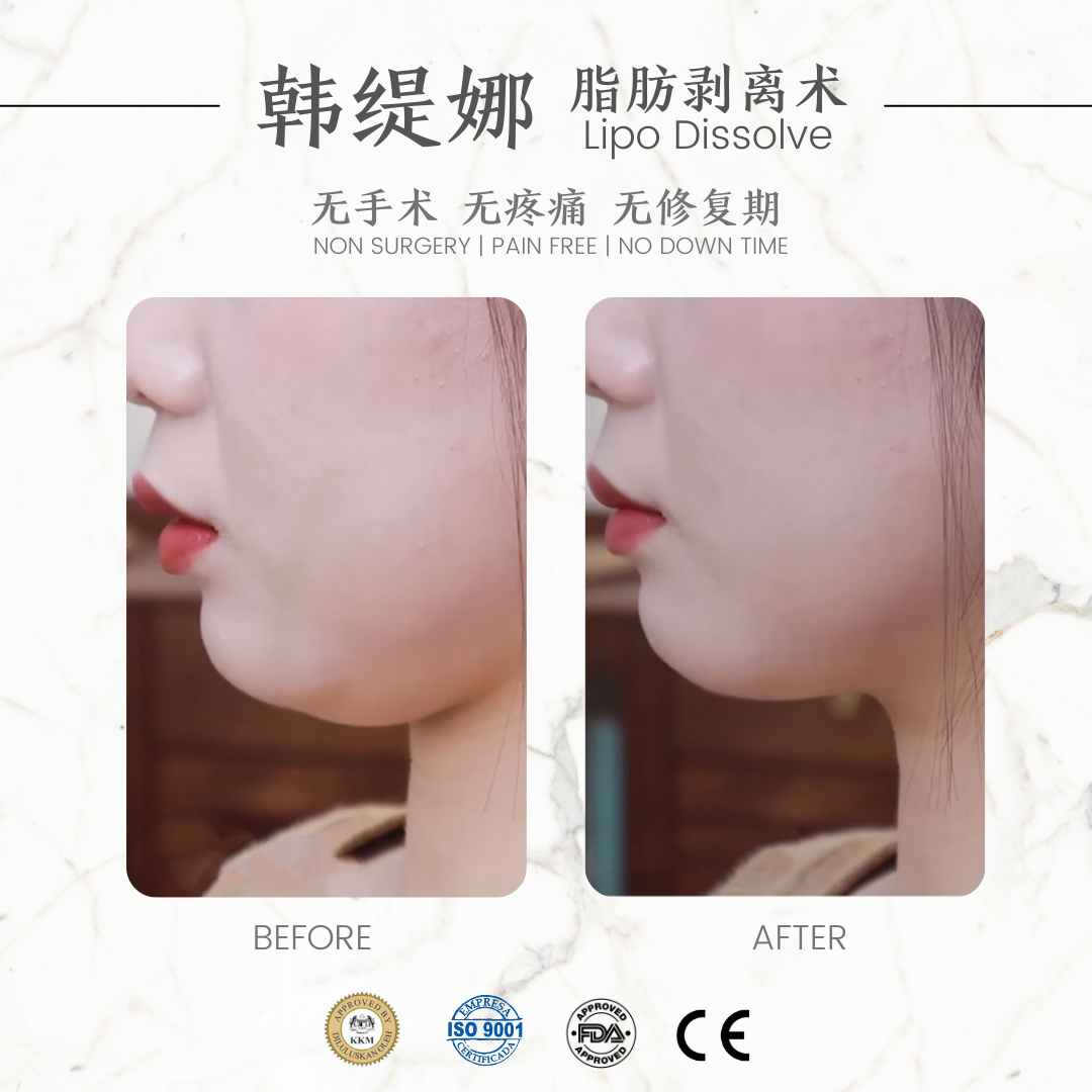 脂肪剥离术