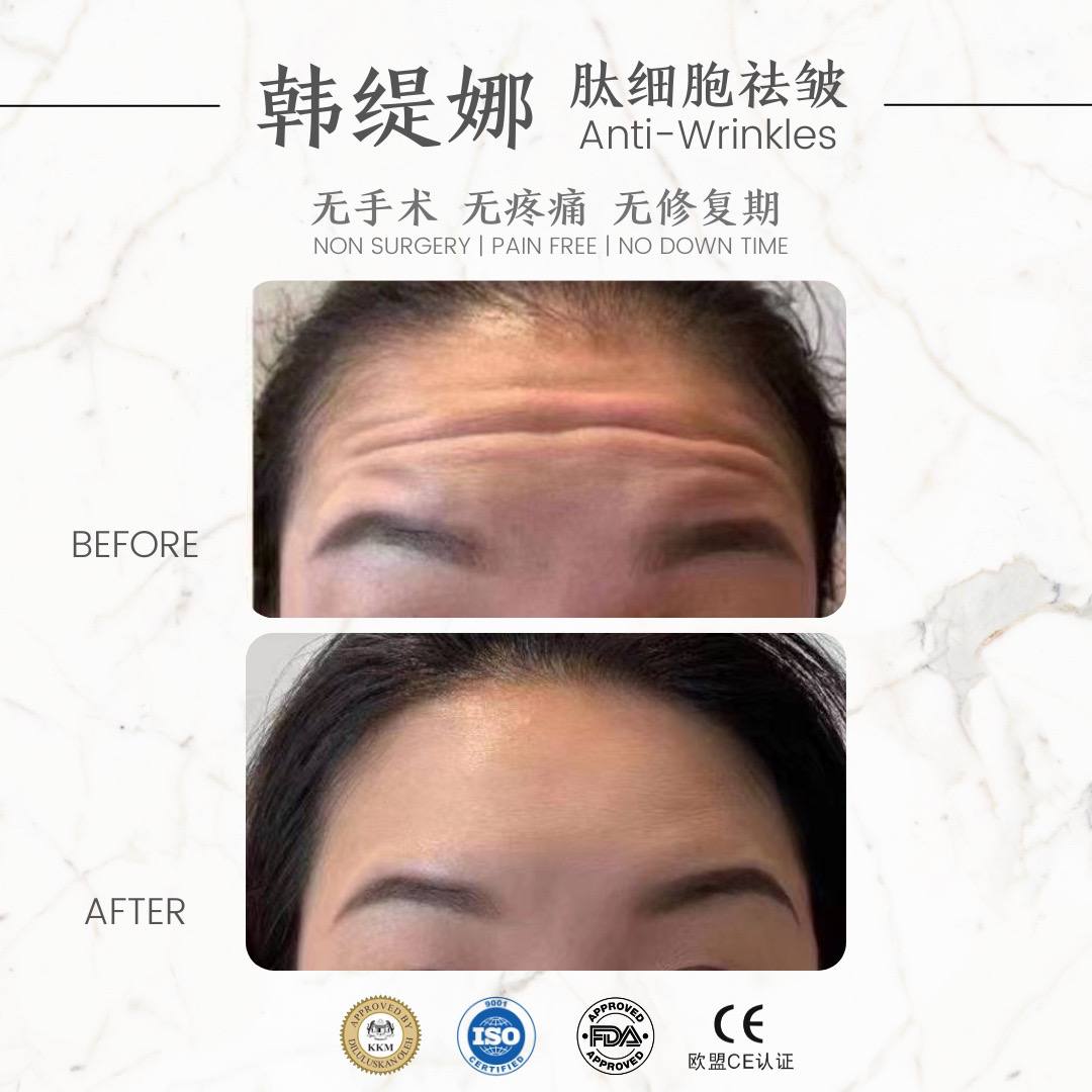 Anti forehead wrinkle 祛抬头紋