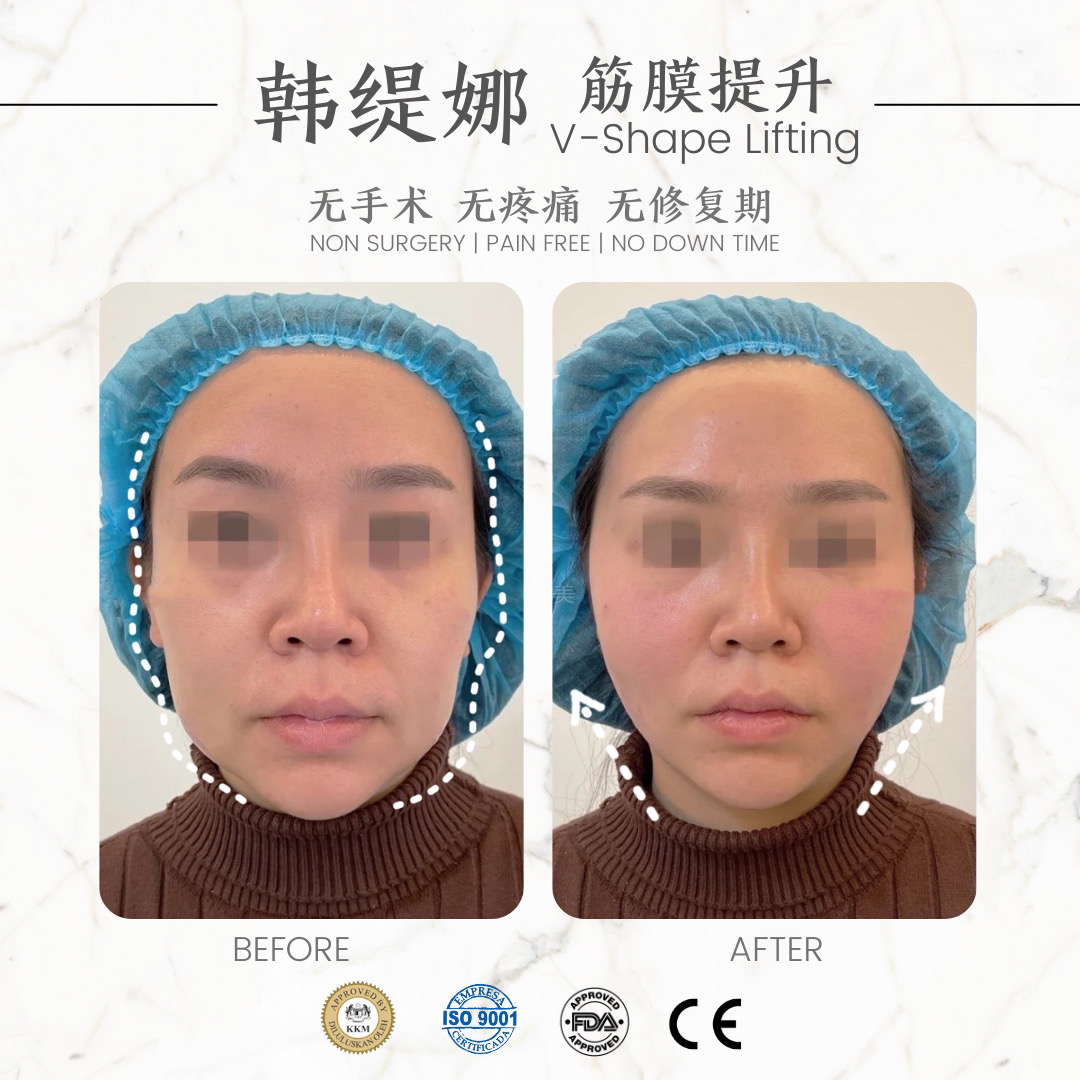 筋膜提升
