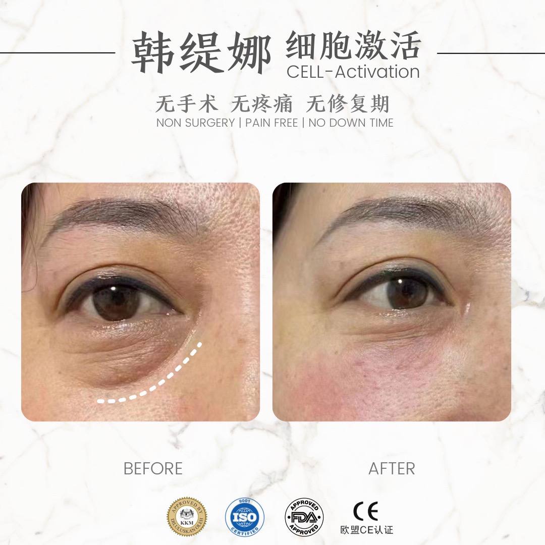 Anti black eye back 祛黑眼圈