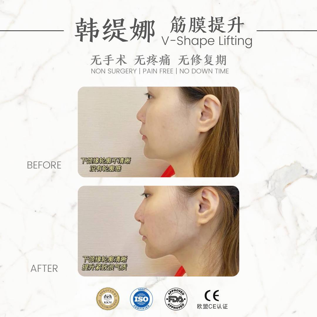 V shape face 小V脸