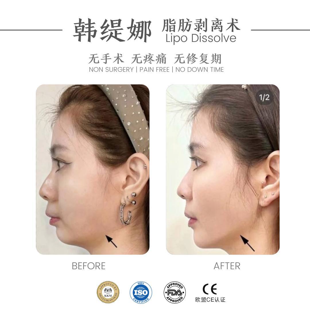Anti Double chin 祛双下巴