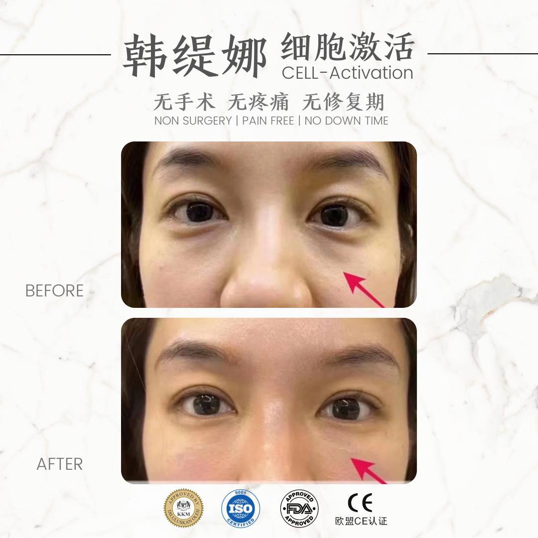 Anti eye bag 祛黑眼圈眼袋