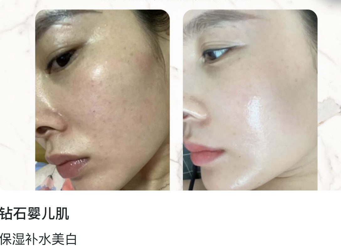 钻石水光肌
