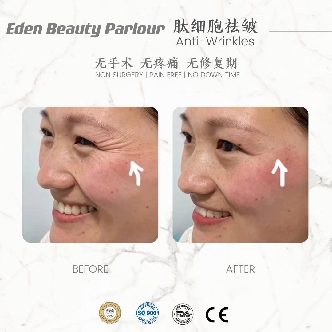 肽细胞祛皱 ：鱼尾纹 ，抬头纹 ，川字纹 ，上庭拉皮，美人线